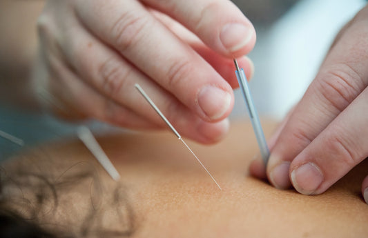 Close up image of acupuncture